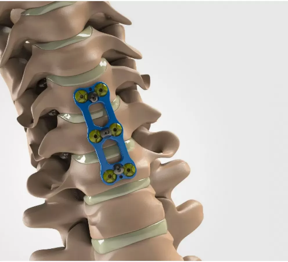 Artrodese cervical 