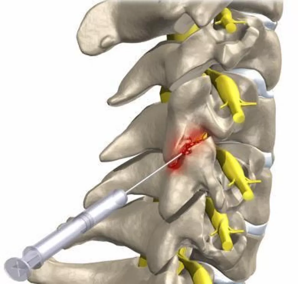 Rizotomia cervical 